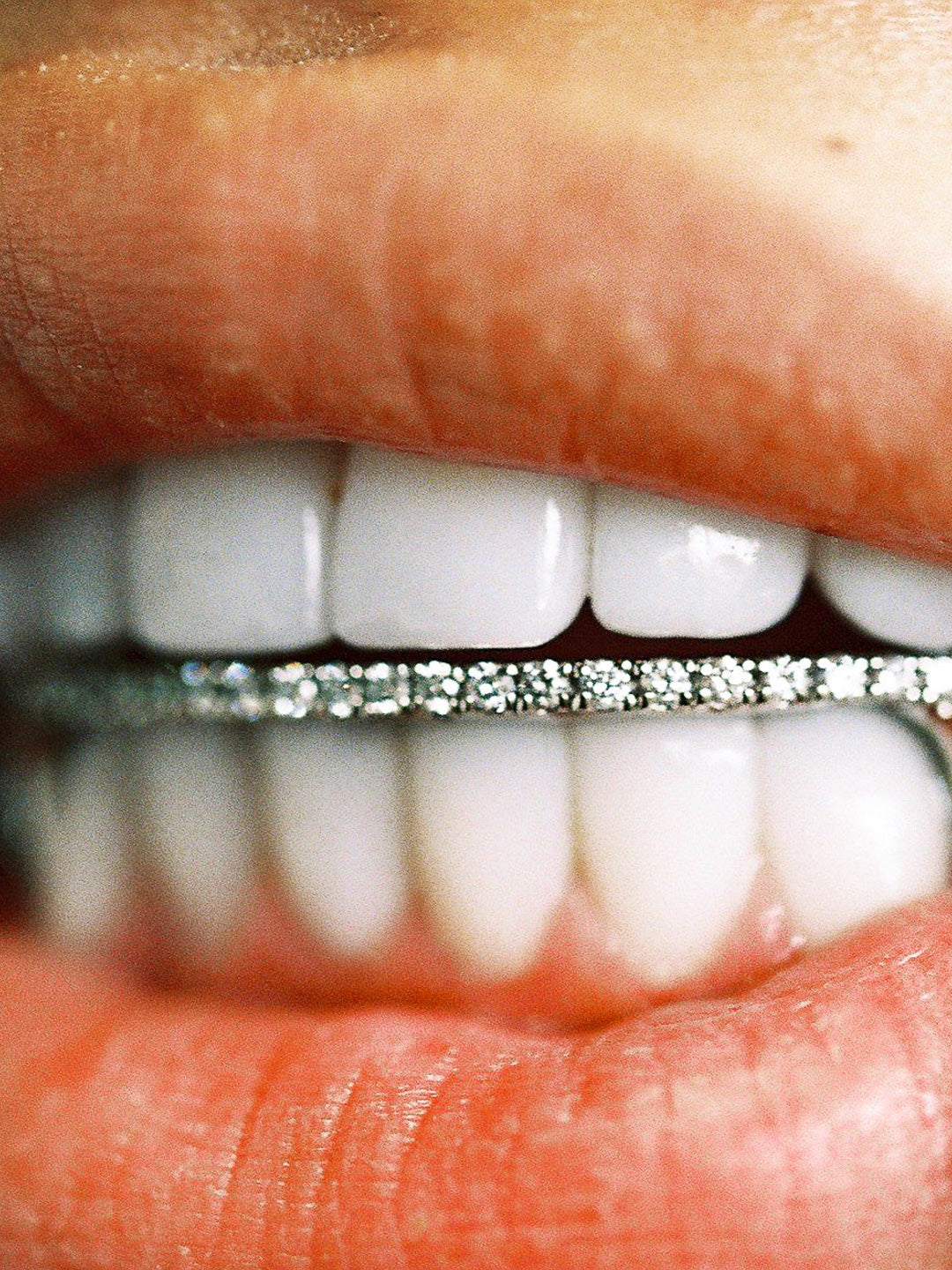 Bridge gap grillz in white gold with a diamond line detail, worn across the front teeth
