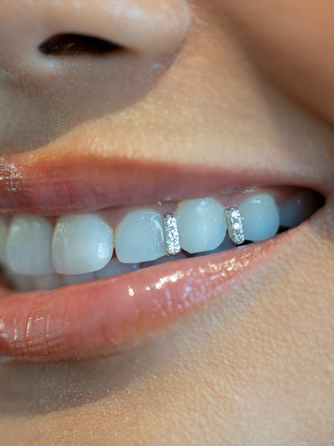Diamond gap grillz in white gold worn on the upper teeth, custom fitted across the front